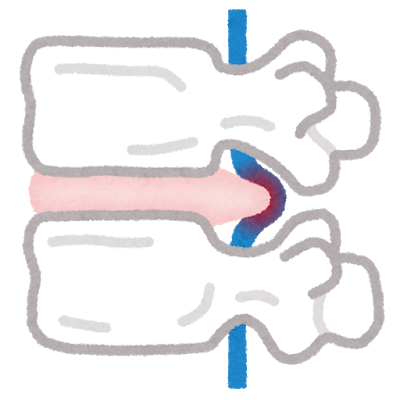 椎間板ヘルニア